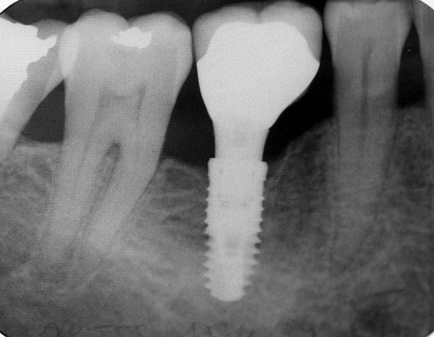 dental implant raleigh nc