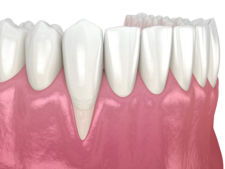 Understanding Gum Recession: Causes, Symptoms, & Treatment Options