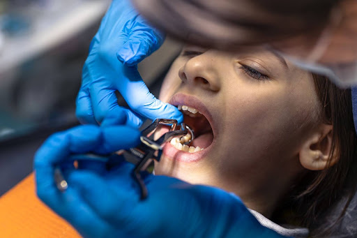 Broken Teeth Extraction